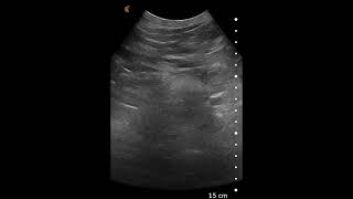 Abdominal Aortic Aneurysm AAA  Ultrasound Image Interpretation [upl. by Joshia]