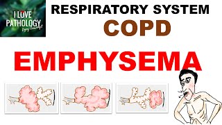 Chronic Obstructive Pulmonary Disease Part 1 Emphysema Pathology [upl. by Ingra]