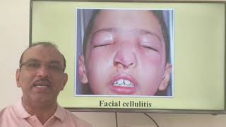 Nasal vestibulitis Hindi Patient teaching programme [upl. by Alberto161]