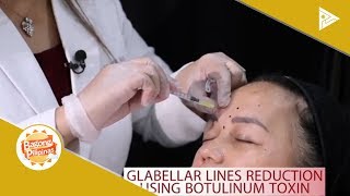 DERMAESTHETIQUE Glabellar lines reduction [upl. by Ahsikar]