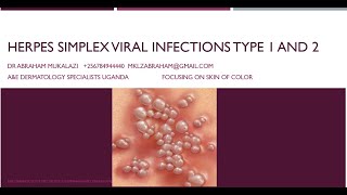 HERPES SIMPLEX VIRUS 1 amp 2 INFECTIONSeducation funny skincondition std skindisease [upl. by Anaujal314]