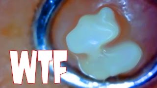 Popping Whiteheads Worlds Largest Blackhead Channel [upl. by Aundrea]