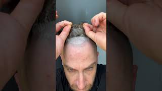 Hairline Check yes or no hairlosssolution confidenceboost menshairreplacement [upl. by Jarek]