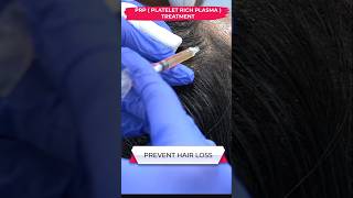 PRP HAIR LOSS PROBLEM skincare prp pigmentation hair hairloss alopeciahairloss beauty [upl. by Hawker]