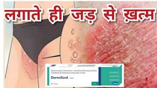 Dermiford Cream  Uses Side effectsReviews Composition In Hindi [upl. by Amyas621]