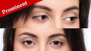 How to immediately know if your eyes are PROMINENT or PROTRUDING [upl. by Jariah]