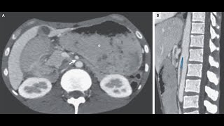 Arteria mesenterica superior Syndrom [upl. by Hutchins]