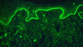 Direct immunofluorescence for autoimmune bullous diseases [upl. by Annah]