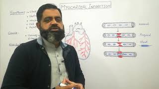 Myocardial infarction Urdu Hindi medium profmasoodfuzail Heart attack  Angioplasty [upl. by Ena]