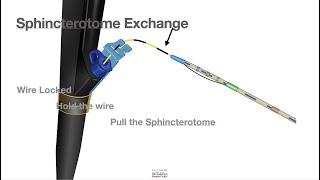 HCC 147419b Rapid Exchange Sphincterotome [upl. by Themis]