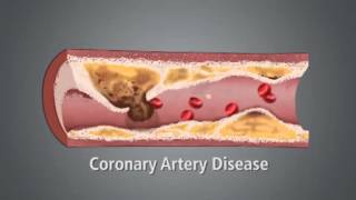 What causes a heart attack [upl. by Goddard]