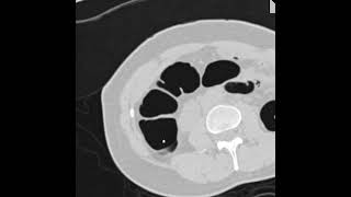 Prominent ileocecal valve [upl. by Eninahpets]