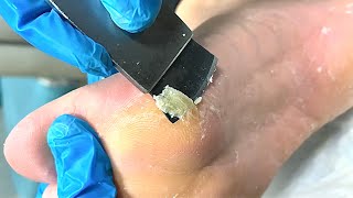 Callus removal from feetampFoot scraping dead skin【Xiao Yan pedicure】stress 703 [upl. by Drescher]