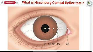 How to perform a hirschberg test  Hirschberg test explained  Interpretation of hirschberg test [upl. by Vinia413]