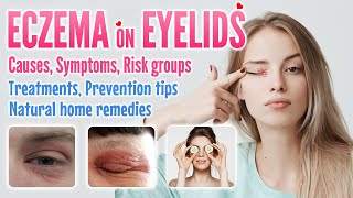 Eczema on Eyelids Causes Symptoms Risk factors Treatment Prevention and Home Remedies Options [upl. by Rodenhouse853]