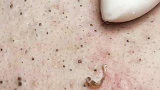 LOOK AT THIS FACE HOW IS FULL OF BLACKHEADS 😨SATISFYING VIDEO relaxing blackheads [upl. by Eskil]