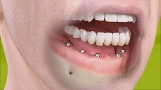 Straumann  Fixed restoration with 46 implants all straight [upl. by Darrin]