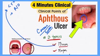 Aphthous Ulcer Explained Like Water  Symptoms Pathophysiology Treatment  Bengali Medicine Lecture [upl. by Nyleek846]