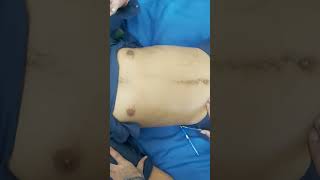 Abdominal examination  Splenomegaly  Jaundice  Anemia  Hemolytic anemia  Clinical skill [upl. by Ayotahc]