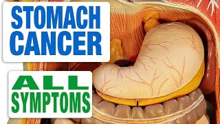 Stomach Cancer  All Symptoms [upl. by Roderich78]