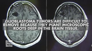 John McCain’s diagnosis What is glioblastoma [upl. by Damales]