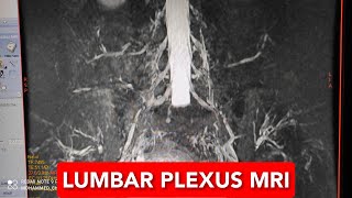 Lumbar Plexus MRI [upl. by Harrell]