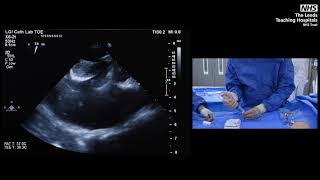 How to start using the Gore cardioform ASD occluder Four simple cases and step by step teaching [upl. by Felske929]