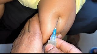 Arms injection video Intramuscular Ceftriaxone 500mg Exephin injection push24 P28 by cannula 69 [upl. by Romola126]