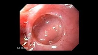 Plummer Vinson Syndrome in Iron Deficiency Anemia in 6 mins Doctor Hospital [upl. by Peednama]