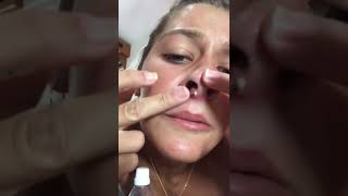 Huge blackheads new 2022  Blackheads new this week tweezers [upl. by Chilt]