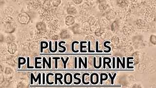 Pus CellsPlenty seen in urine microscopy showing urine tract infectionUTIPyuria seen in urine [upl. by Kerred]