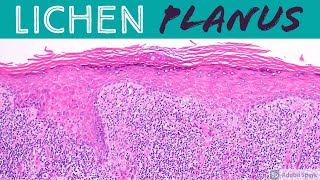 Lichen Planus amp Hypertrophic Lichen Planus Inflammatory Dermpath 101 for Dermatology amp Pathology [upl. by Hartill]