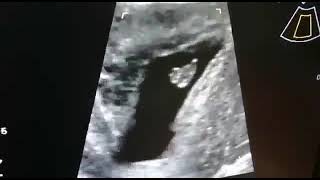 Early Missed Abortion Due To Sub Chorionic Bleed  In Urdu amp Hindi [upl. by Evita]