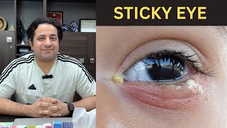 Sticky eyes Causes amp Treatment آنکھوں میں چپچپا پن اور مادہ نکلنا کس بیماری کی علامت ہو سکتا ہے؟ [upl. by Sedrul]