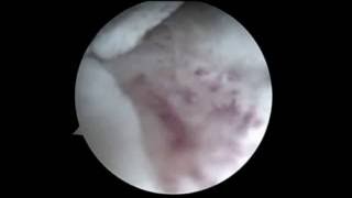 Bankart Repair Revision and Remplisage Surgery for Engaged HillSachs lesion [upl. by Aillicec]