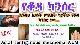 Acral lentiginous melanoma ALM  የቆዳ ካንሰር  የጤና ቃል [upl. by Kurtzig579]