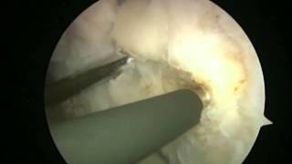 Arthroscopic Latarjet  BristowLatarjet Instability Shoulder System [upl. by Assirual]