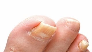 Toenail Fungus Treatment  How to Treat Toenail Fungus FAST With Home Treatments [upl. by Nawd]