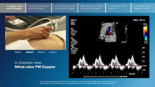 Advanced screening views of the fetal heart  Part 1  4chamber color and PW Doppler [upl. by Llirred]