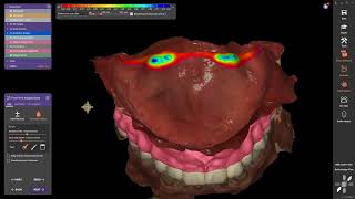 How to create a posterior palatal seal in exocad [upl. by Kaile587]