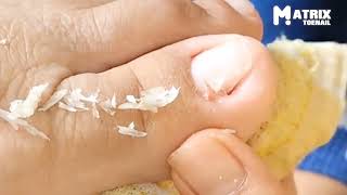 Toenail Cutting and Cleaning  How Toenails Are Professionally Cleaned  Discomfort Toenail Pedicure [upl. by Eeryn]