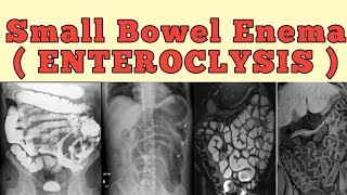 Small bowel enema  Enteroclysis [upl. by Naaitsirhc]