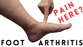 Foot Arthritis Pain Most Common Signs and Symptoms [upl. by Nawrocki442]