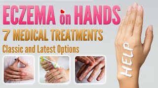 Eczema on Hands Treatment  7 Best Medical Treatment Options for Hand Dermatitis [upl. by Aseiram]