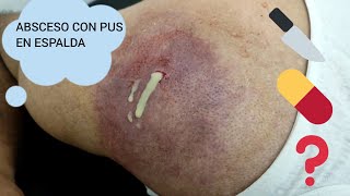 ABSCESO CON PUS EN ESPALDA [upl. by Ahsrav]