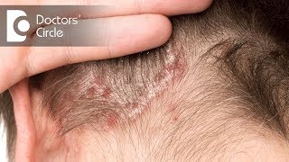 Treatment options for Scalp Psoriasis  Dr Rashmi Ravindra [upl. by Elocal]