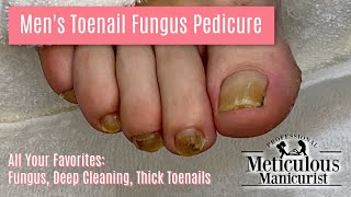 Pedicure Transformation with All Your Favorites  Fungus Deep Cleaning Thick Toenails [upl. by Yetac]