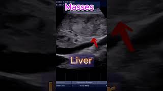 Liver masses  Cancer   Pleural FLuid  Ascites  ultrasound cancer liver mass [upl. by Ellimac58]