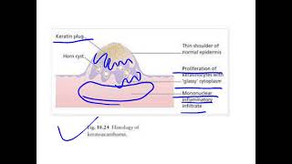 keratoacanthoma [upl. by Iruj]