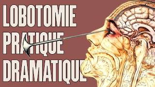 Comment faire une lobotomie  LHistoire nous le dira  235 [upl. by Ariahs439]